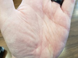 WVU tackles opioid crisis with clinical trial of injectable non-opioid micropellets to treat sciatica pain
